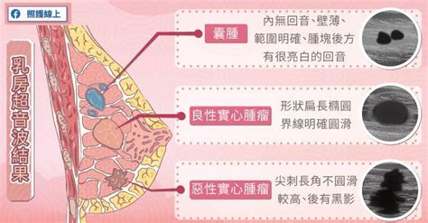 乳房有毛|乳頭長毛是多毛症還是腫瘤？醫師告訴你如何從併發症判斷｜每日